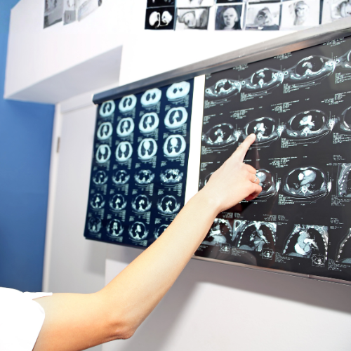 Image-guided varicocele embolization