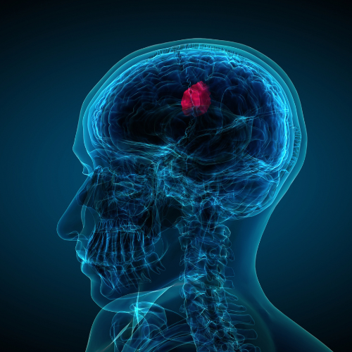 Tumor Ablation