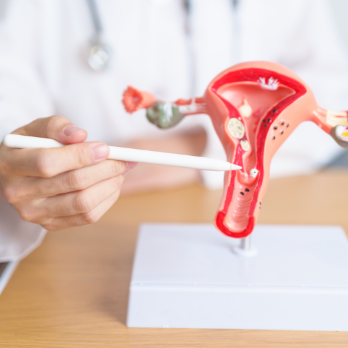 Uterine Fibroid Embolization