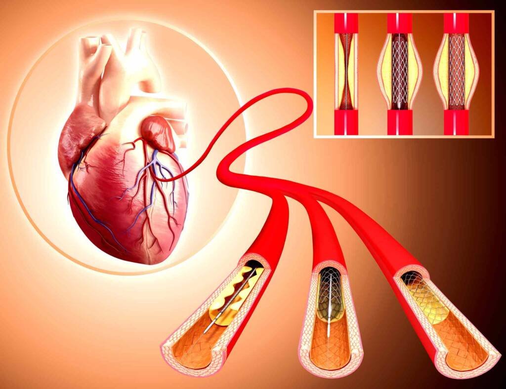 Angiography treatment