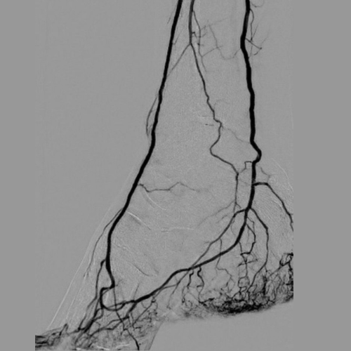 Angiography & Angioplasty