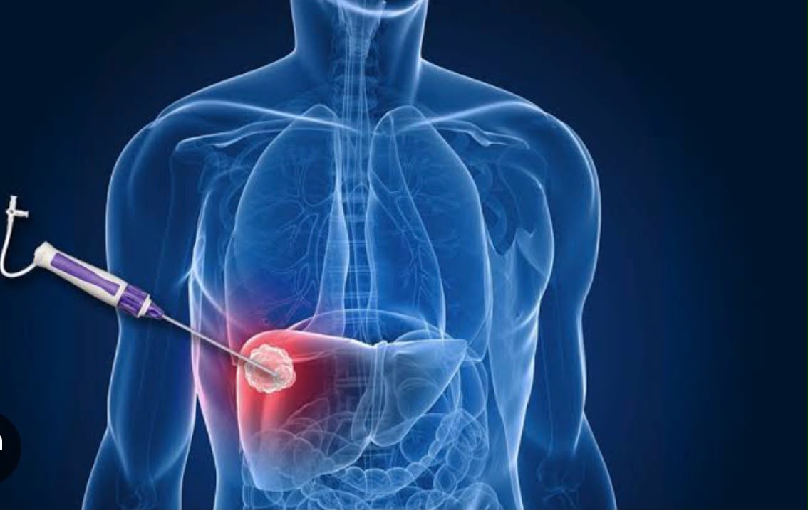 Tumor Ablation Treatment