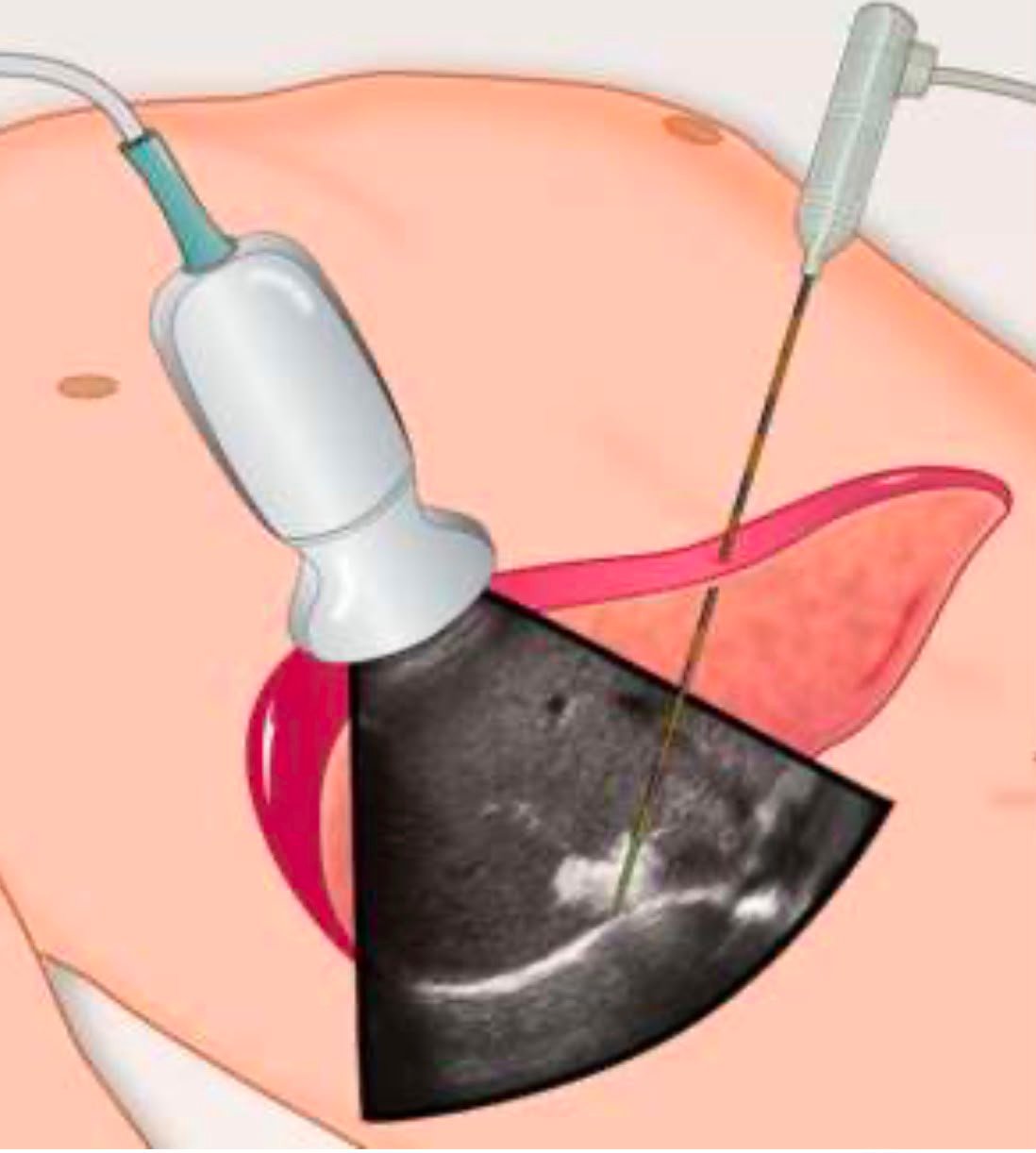 Image Guided Tumor Ablation
